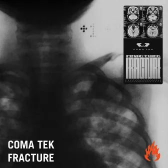 Fracture by Coma Tek