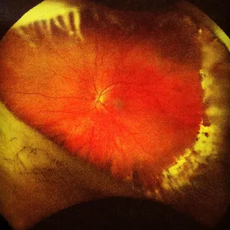 Scleral Buckle by Raymond Richards