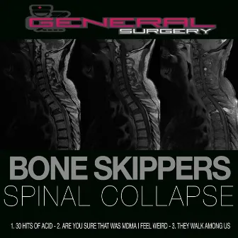 Spinal Collapse by Bone Skippers