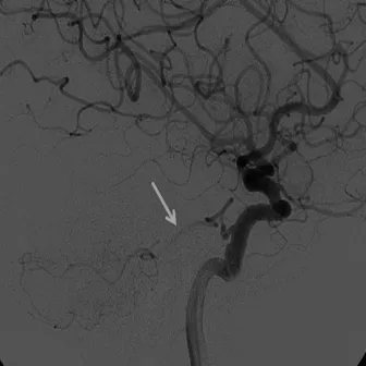 Subarachnoid Haemorrhage by Mademoiselle Bistouri