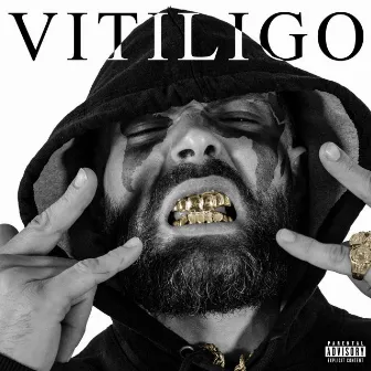 Vitiligo by C - Lopez