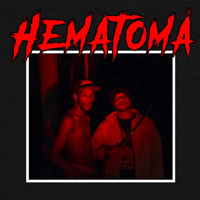 Hematoma