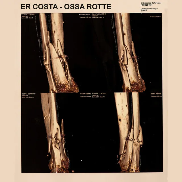 Ossa rotte