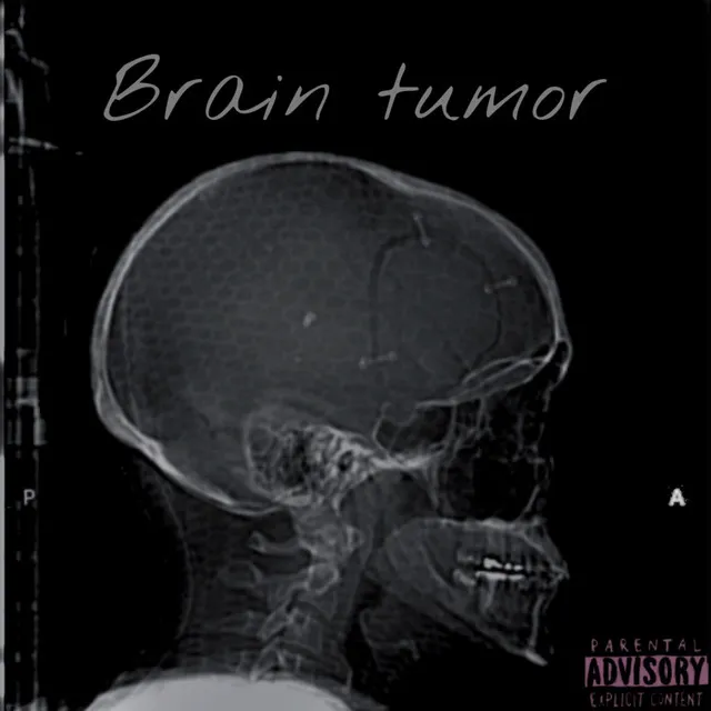 Brain tumor