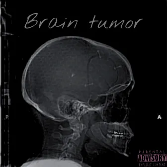 Brain tumor by HeartInTheShore