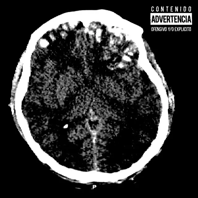 Contusión Cerebral