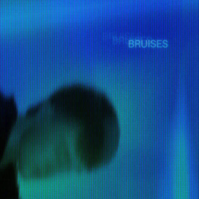 Bruises