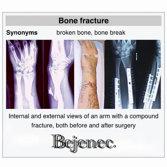 Bone Fracture by Bejenec